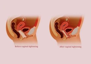 Understanding Menopause